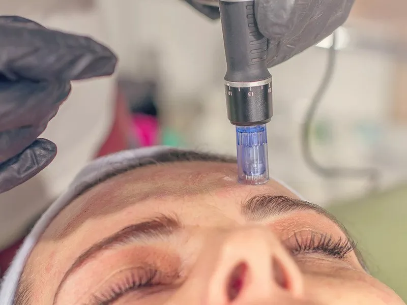 Mikrojehličková radiofrekvence: Omlazující procedura obličeje