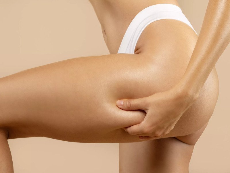 Neinvazivní liposukce: Ultrazvuková kavitace