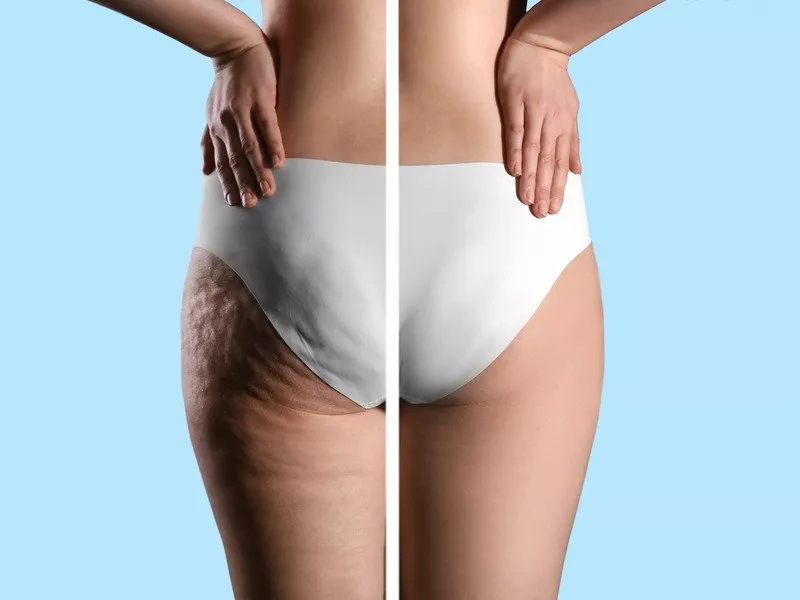 Neinvazivní liposukce: Ultrazvuková kavitace